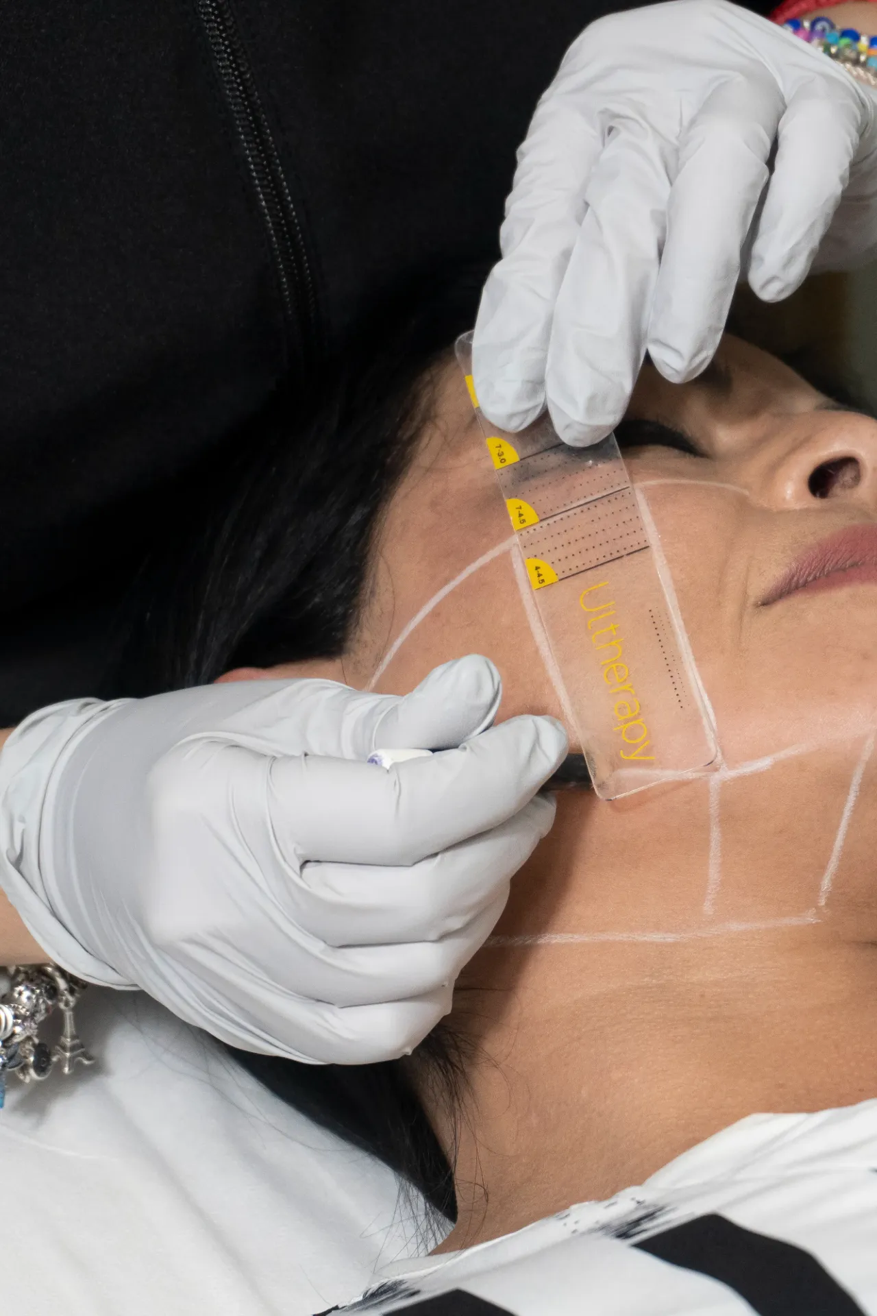 Ultherapy
