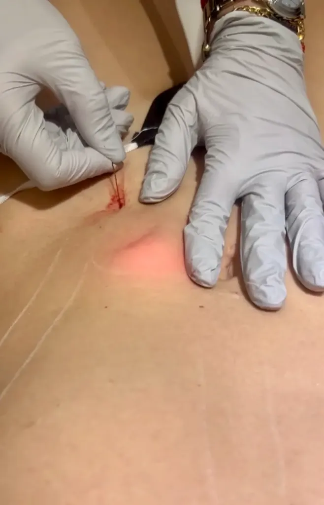 Endolift Corporal