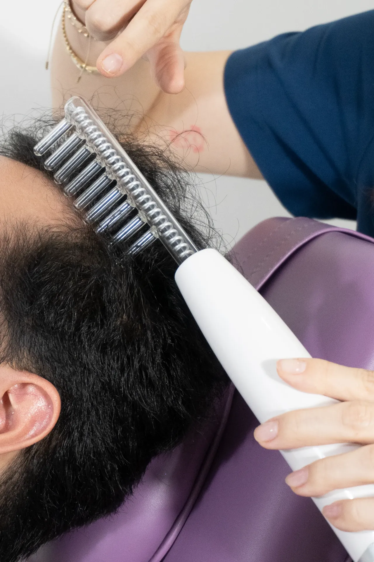 Scalp Mesotherapy